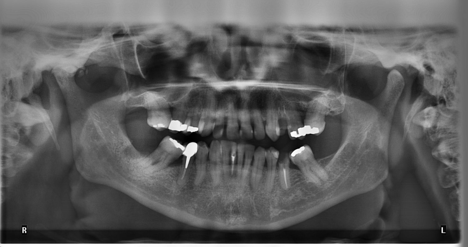 Everything You Need to Know About Dental XRays