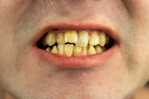teeth calcified