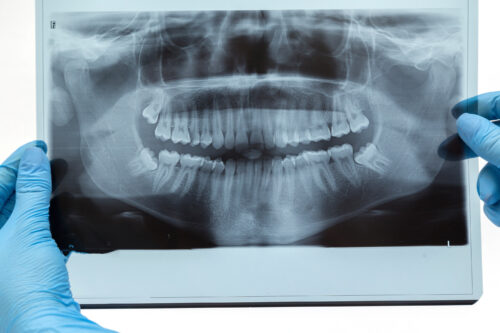 tooth x-ray