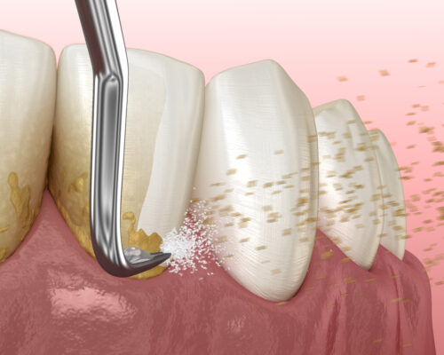 dental plaque gums tools