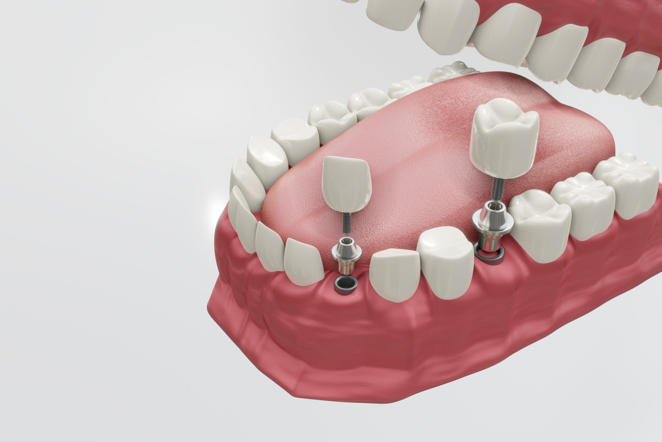 dental implants
