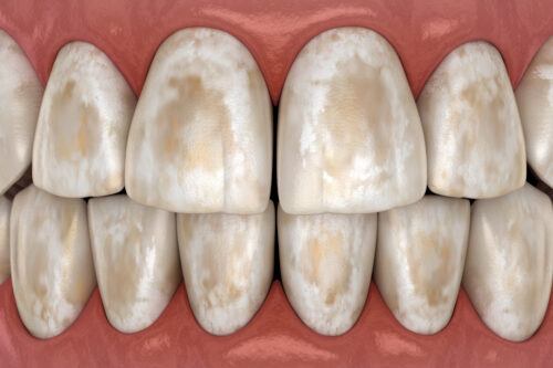 tooth enamel