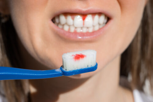 bleeding gums blood on toothbrush