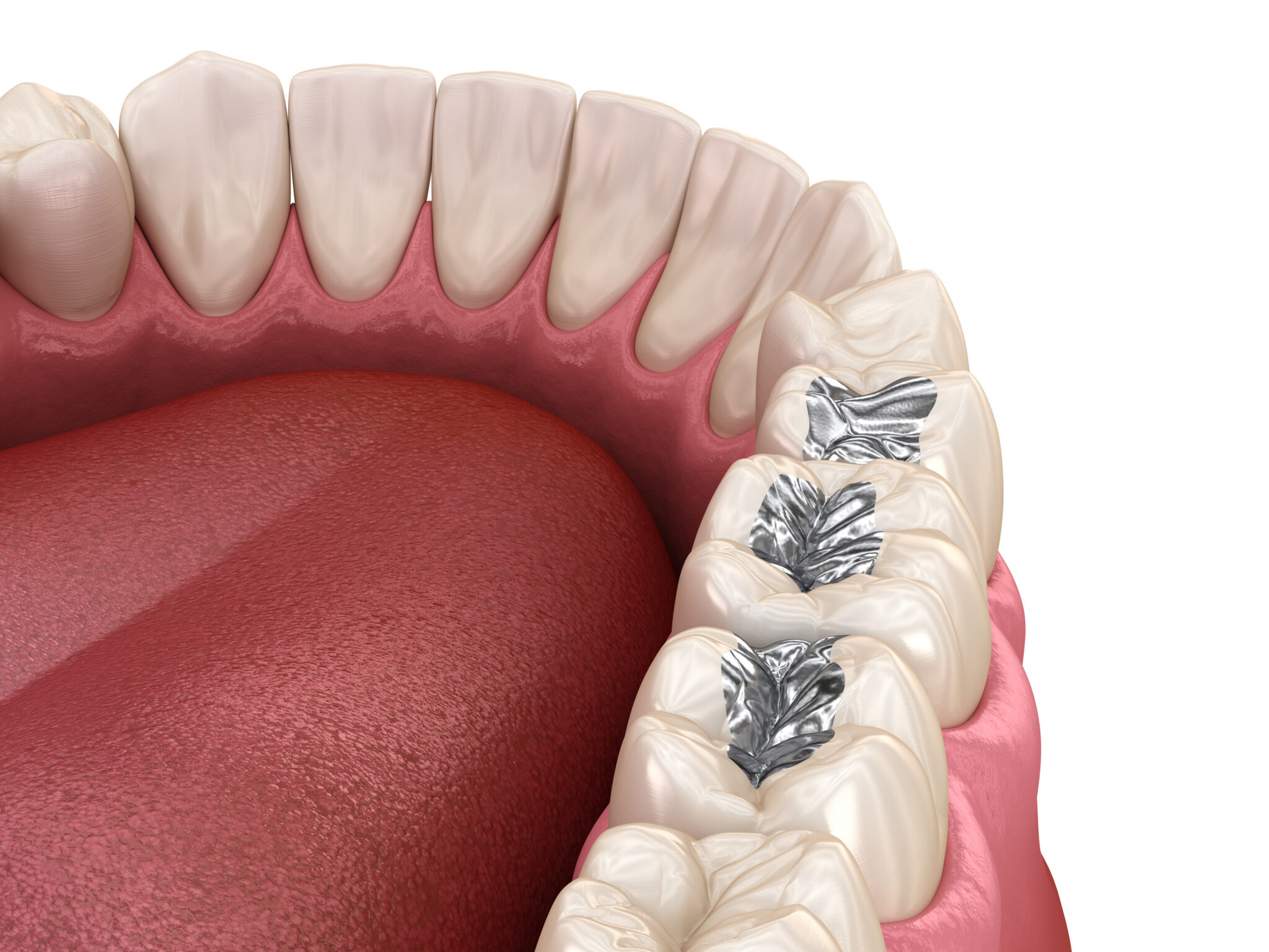 Dental Amalgam Fillings Is it Safe?