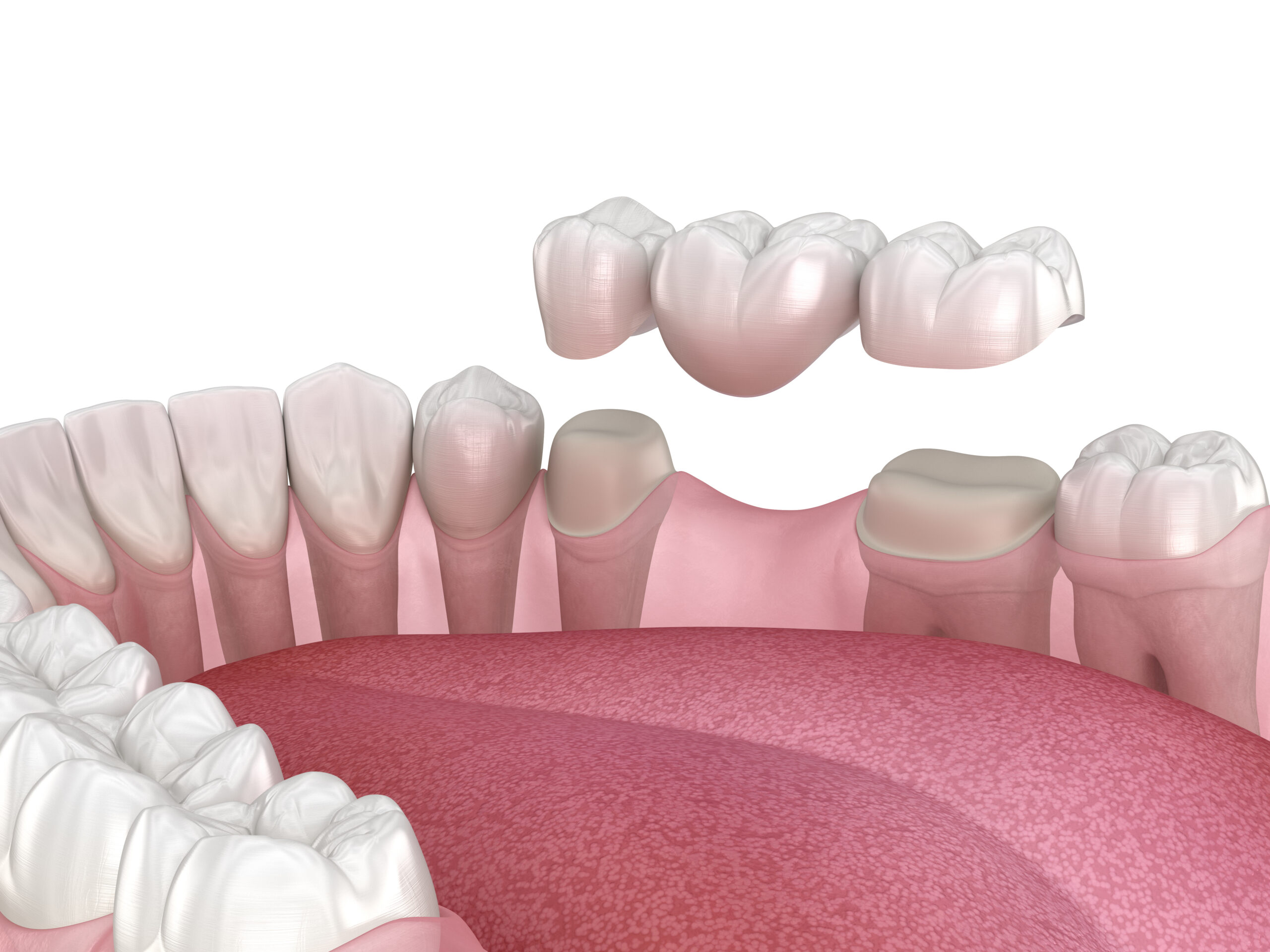 Dental bridge of 3 teeth over molar and premolar. Medically accurate 3D illustration of human teeth treatment