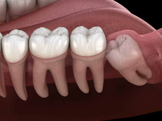 Wisdom tooth with impaction at molar tooth. Medically accurate tooth 3D illustration