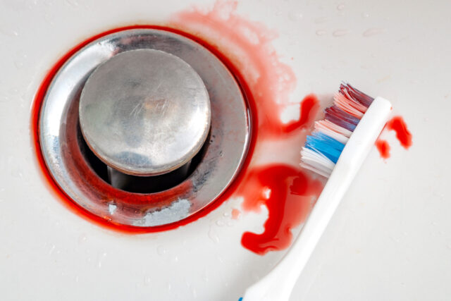 Bleeding gums when brushing the teeth and gingivitis concept theme with close up on a dental floss pick covered in blood and doped in a bathroom sink