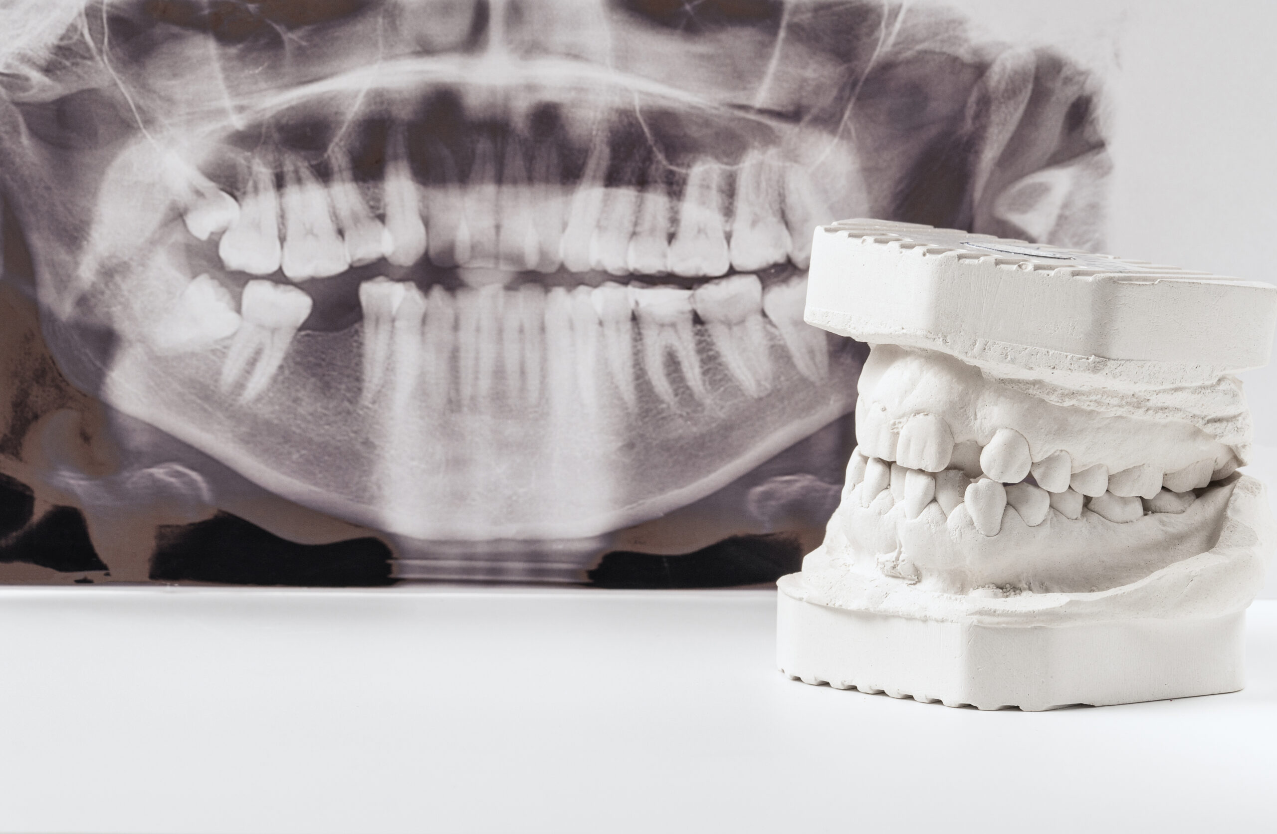 Dental casting gypsum model of human jaws with panoramic dental x-ray . Crooked teeth and distal bite. Shots were made before treatment with braces.