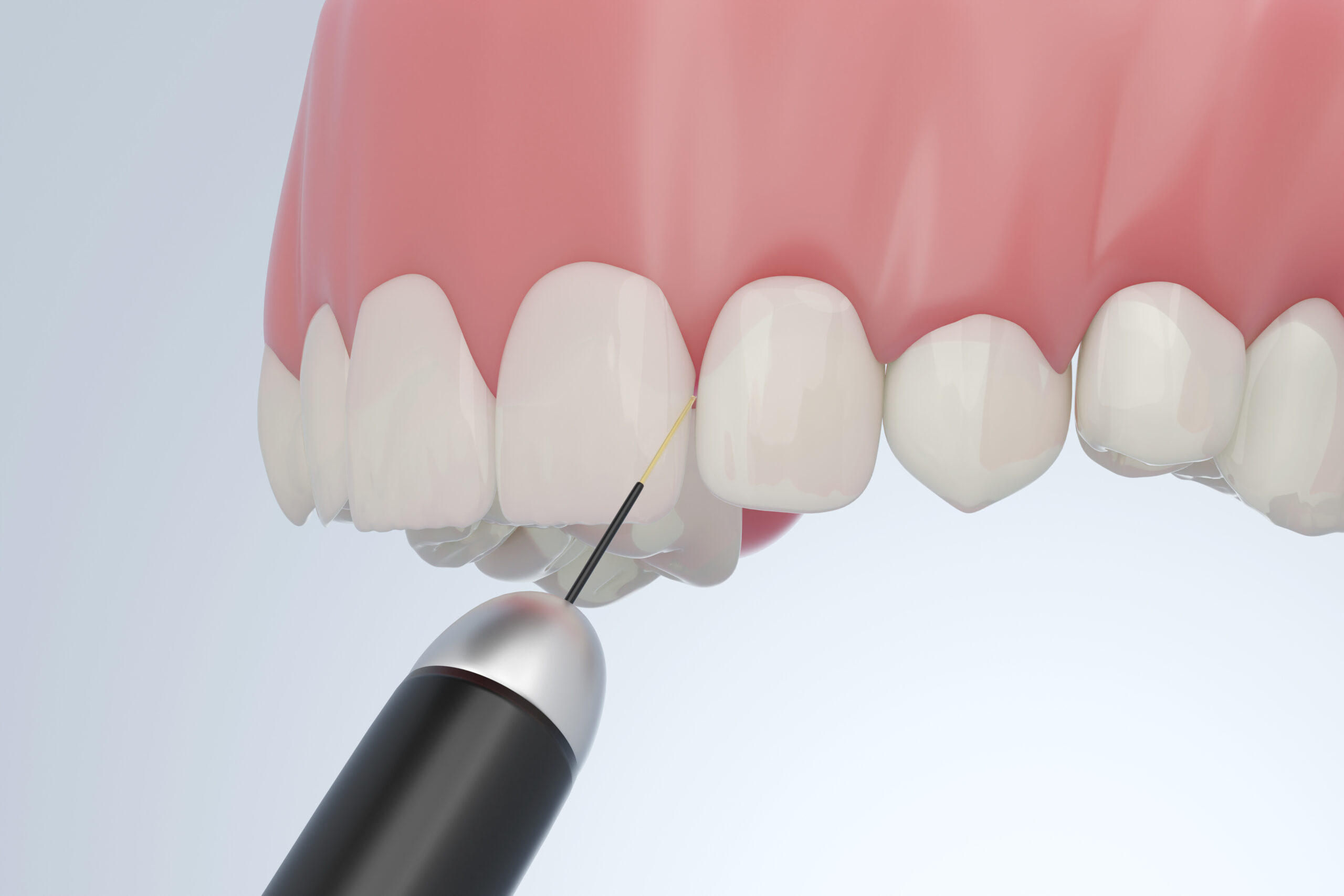 Dental laser with upper front teeth and gums for dentistry laser treatment concept. 3D rendering.