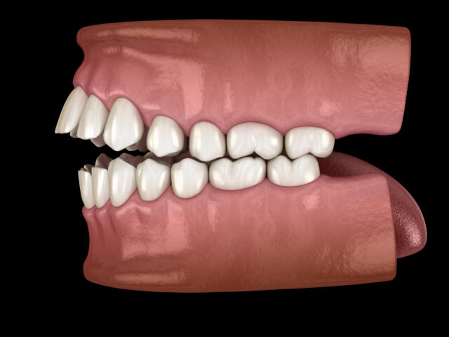 Open bite dental occlusion ( Malocclusion of teeth ). Medically accurate tooth 3D illustration