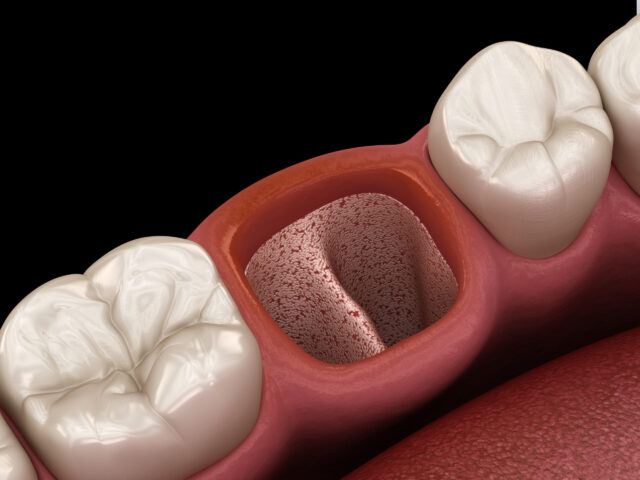 Alveolits - opened dry soket after tooth extraction. Medically accurate 3D illustration